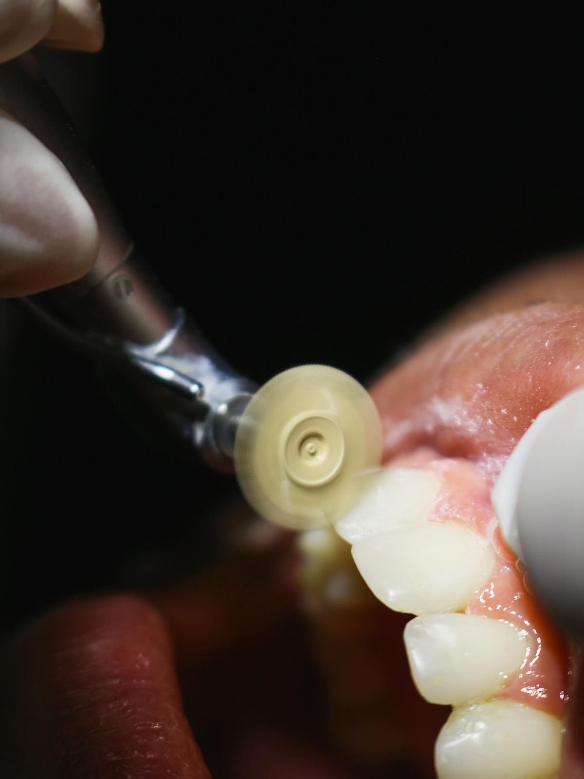 Pulido de restauración dental, macro intraoral.